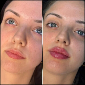 How Fillers Treatment in Dubai Makes You Look Younger
