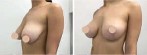 Transform Your Body with Breast Reduction in Dubai: Results You’ll Love