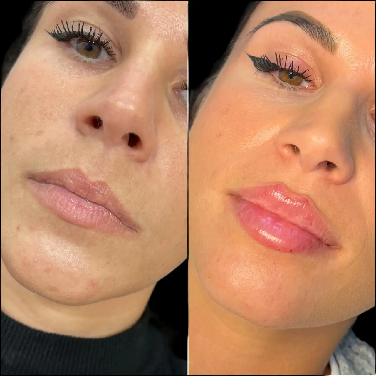 Fillers Treatment in Dubai