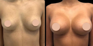 How Breast Augmentation in Dubai is Redefining Aesthetic Trends in the Middle East