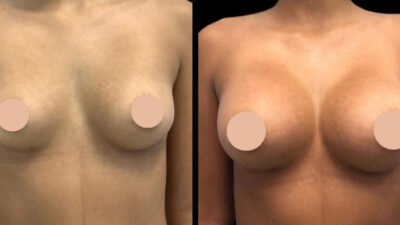 How Breast Augmentation in Dubai is Redefining Aesthetic Trends in the Middle East