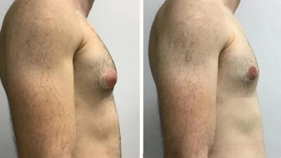 gynecomastia in dubai