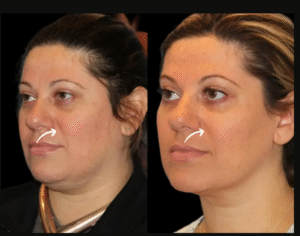 Sculptra Fillers Treatment in Dubai – Cultural Attitudes Towards Collagen Stimulators