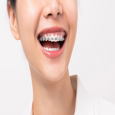 Teeth Braces in Riyadh