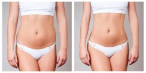 The Benefits of Fat Transfer in Dubai: Natural Enhancement for Your Body