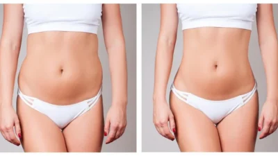 The Benefits of Fat Transfer in Dubai: Natural Enhancement for Your Body
