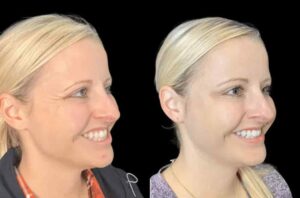 Botox Treatment in Dubai A Popular Choice for Anti-Aging
