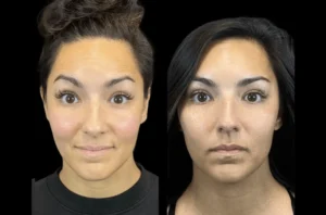 Combining Skincare and Botox Treatment in Dubai for Maximum Results