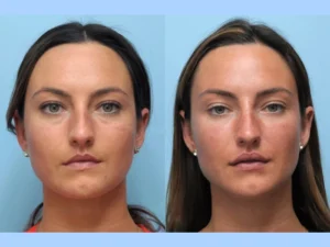 Is Thread Lift Treatment in Dubai Worth the Investment