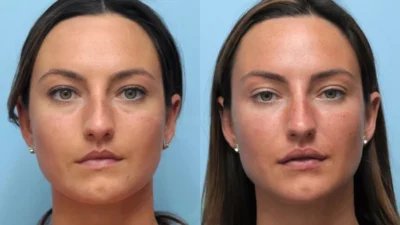 Is Thread Lift Treatment in Dubai Worth the Investment