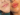 Juvederm