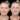Under-Eye-Fillers in Dubai