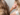 hair transplant