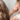 hair transplant