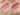 Dermal Fillers