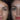Septoplasty in Dubai