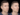 Jawline Fillers