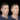 Jawline Fillers