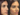 Nose Surgery in Dubai