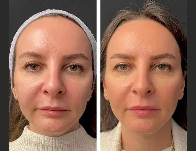 Mesotherapy in Dubai