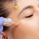 microneedling