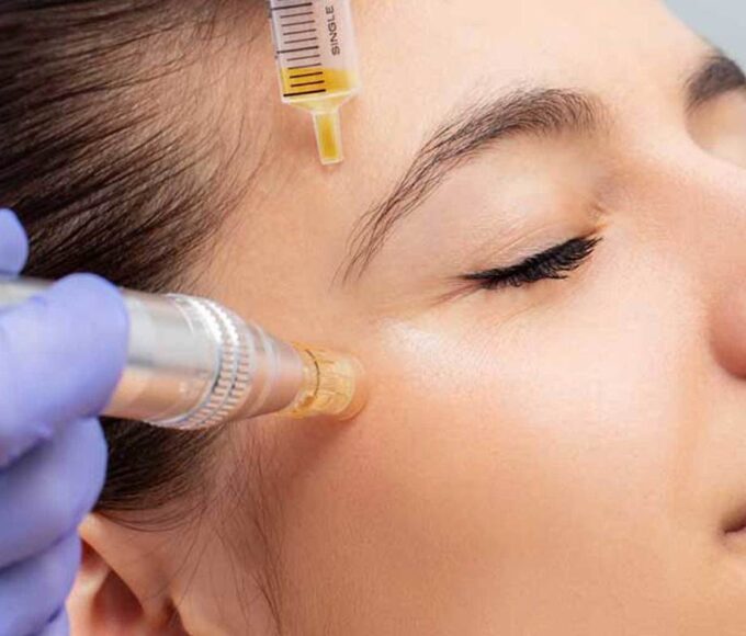 microneedling