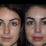 H Rhinoplasty 15 11zon