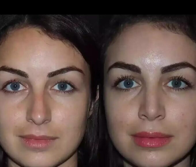 H Rhinoplasty 15 11zon