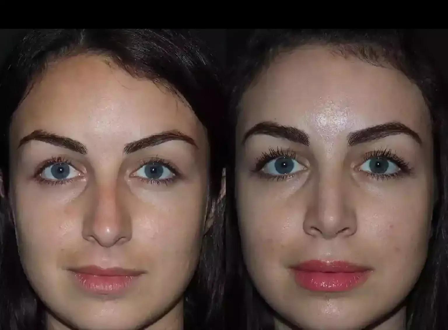 H Rhinoplasty 15 11zon