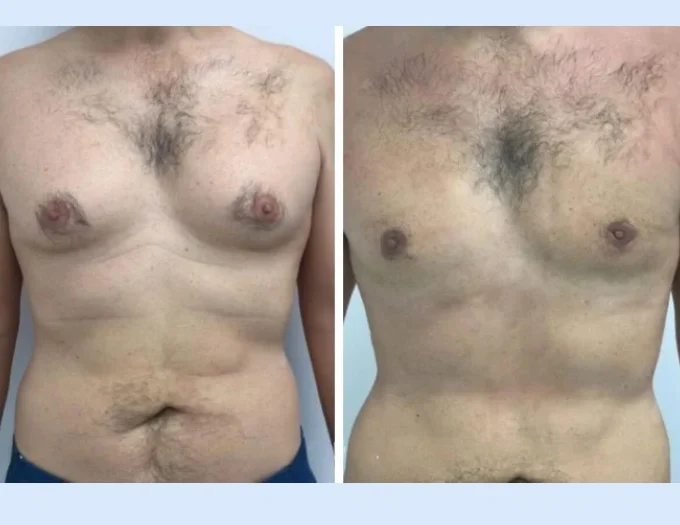 H4 Gynecomastia 1