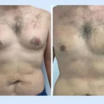 H4 Gynecomastia