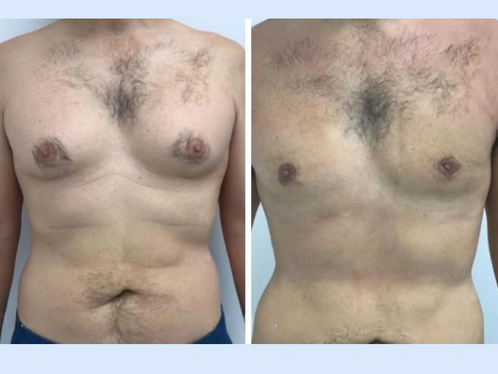 H4 Gynecomastia