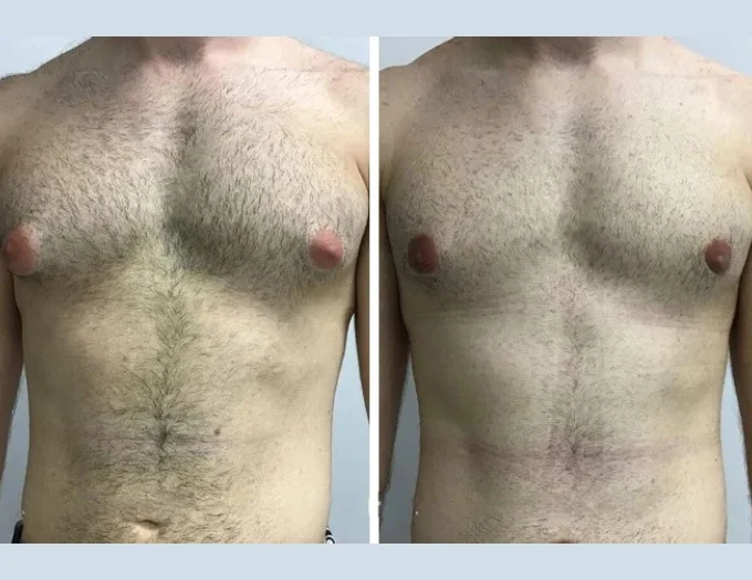 Gynecomastia in Dubai