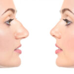 Rhinoplasty in Dubai