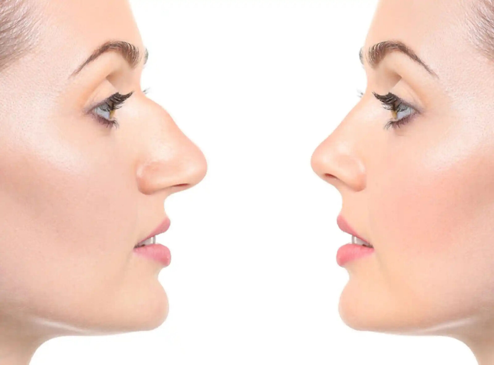Rhinoplasty in Dubai