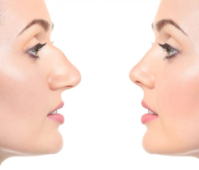 Rhinoplasty in Dubai