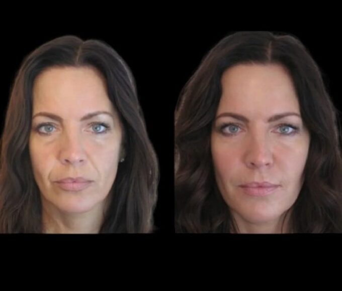 Jawline Fillers in dubai